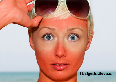 آفتاب سوختگی و روشهای درمان آن