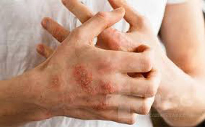 حساسیت پوستی ایجاده شده پس از مصرف دارو-تالگوشیدلون