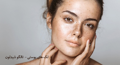 لک پوستی، تالگوشیدلون