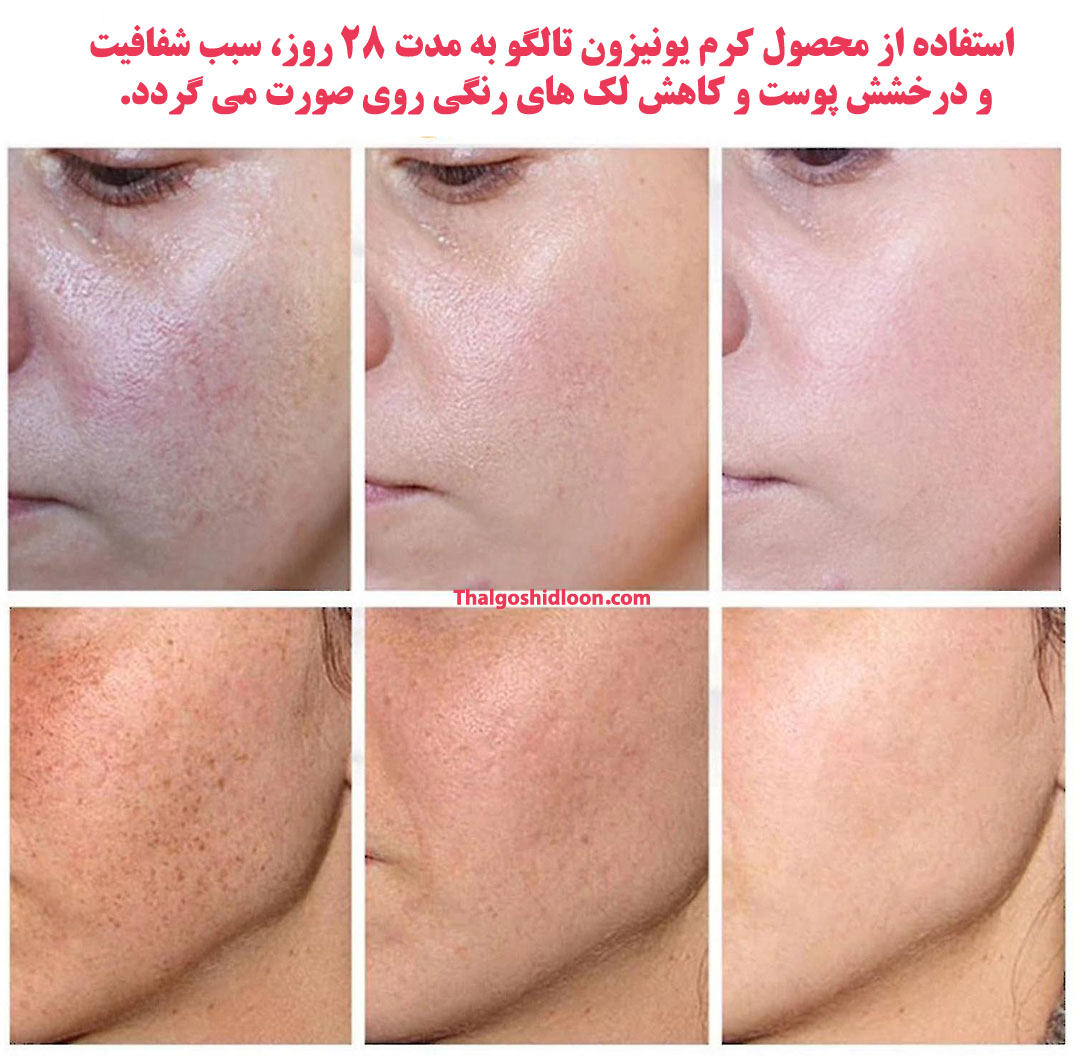 درمان لک های صورت بعد از 28 روز با کرم ضدلک یونیزون تالگو