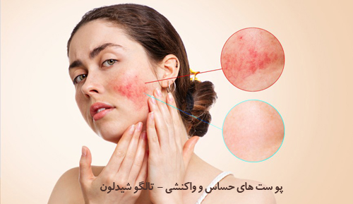 التهاب و حساسیت پوستی، تالگوشیدلون