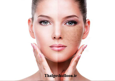 علت تیرگی پوست و روشهای درمان آن