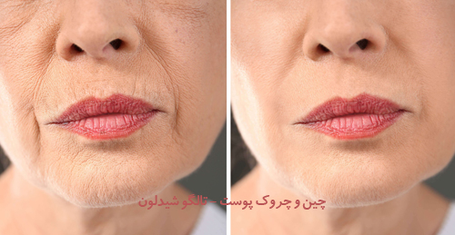 چین و چروک پوستی، تالگو شیدلون